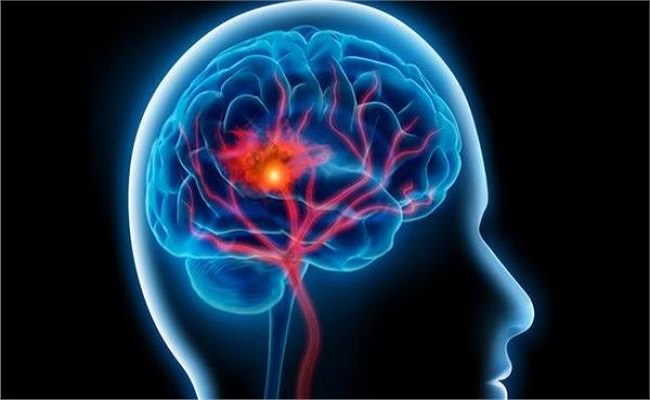 تقنية ذكاء اصطناعي تنقذ ضحايا السكتة الدماغية بنسبة 48%‎‎...