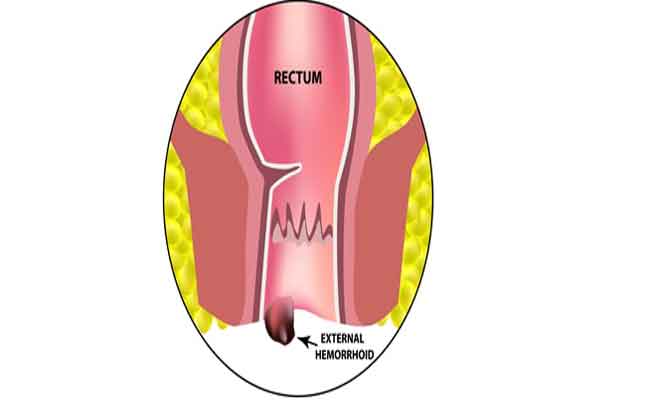ما هي أفضل طرق علاج البواسير منزلياً؟