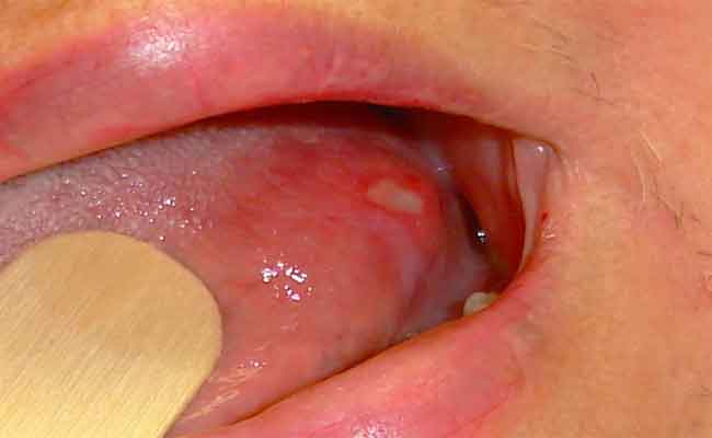 كيف نعالج حبّة السخونة في اللسان؟