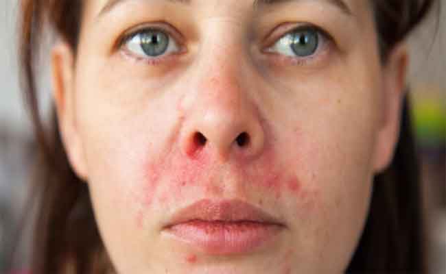 كيف يمكن أن تحمي بشرتكِ من الالتهابات؟