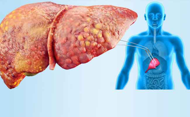 هل يمكن للسكر أن يؤدي الى الاصابة بالكبد الدهني؟