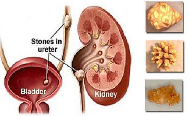 كيف يمكن ان تحموا أنفسكم من مشكلة حصى الكلى؟