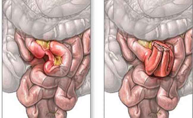 كيف يتمّ علاج شلل الأمعاء؟