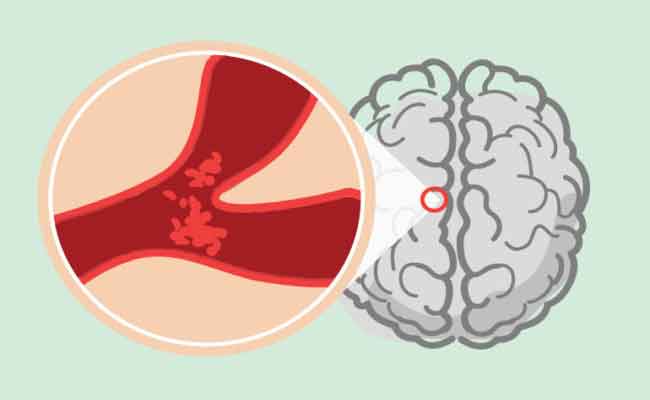 7 أشياء يمكنكم القيام بها للوقاية من السكتة الدماغية…
