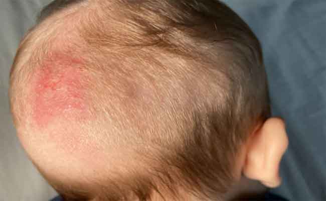 كلّ ما يجب ان تعرفوه عن سعفة الرأس وطريقة علاجها