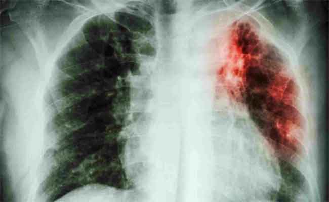 ما هي العلاجات التي يجب اتباعها عند الاصابة بتليف الرئة؟