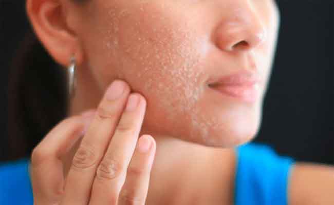 لماذا يمكن أن تتقشّر بشرة وجهكِ؟