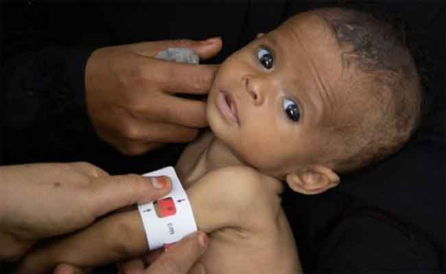 سوء التغذية خطر يهدّد صحّة الطفل…اليكم الأمراض الناتجة عنه!