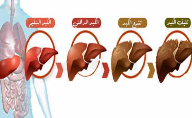 ما هي الأعراض التي تُشير الى تراكم السموم في الكبد؟