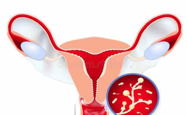 كيف يمكن أن تعالجي التهاب المهبل الفطريّ؟