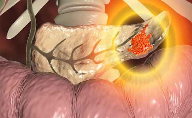 اكتشفي الفرق بين التهاب البنكرياس وسرطان البنكرياس…