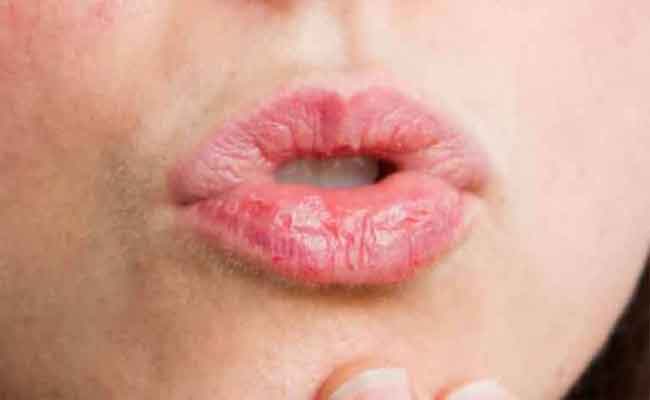 علاج فطريات الشفايف في المنزل بفعالية…والطرق الوقائية