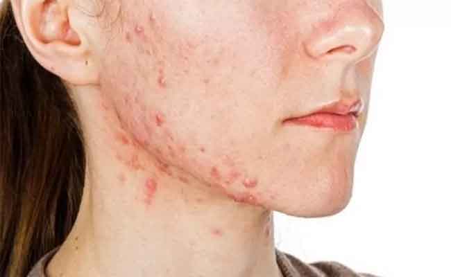 الفرق بين حب الشباب الهرموني والبكتيري…فهل هما مختلفان؟