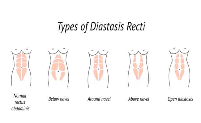 أعراض الانفصال العضلي…الحمل أبرز أسبابه والعلاجات متاحة