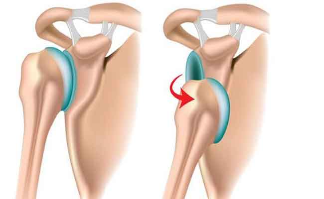 أعراض خلع الكتف عند الكبار…الأسباب والعلاجات المتاحة