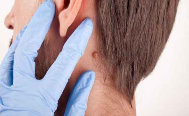 هل تعانون من ثآليل الرقبة؟ اليكم أسباب ظهورها وعلاجها