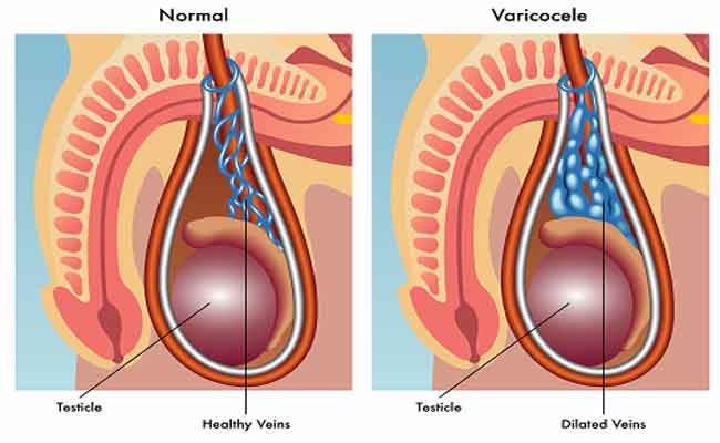 اذا كنتَ تعاني من دوالي الخصية…لماذا تُعتبر الجراحة مهمّة لك؟