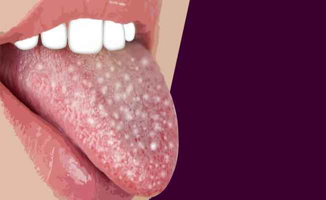 فطريات اللسان…ما أسبابها؟