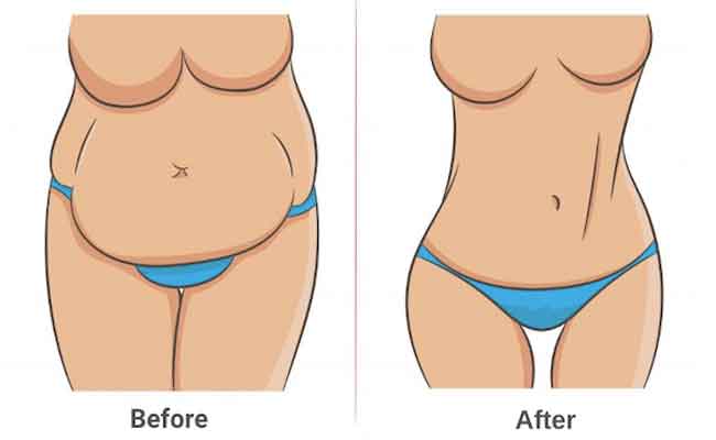 التجميل ما بعد الأمومة The Mommy Makeover…