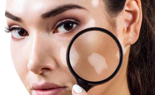 البهاق: علاج جديد أثبت فاعلية عالية جداً على الوجه خصوصاً