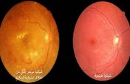 علاقة مرض السكر بشبكية العين...الجديد في علاج الشبكية ورشح العين والاعتلال الشبكي السكري