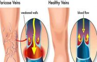 دوالي الساقين...أنواعها وأعراضها وطرق العلاج