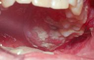 سرطان الفم والحلق: عدوى فيروسية قد تسبب المرض، فما الحل؟