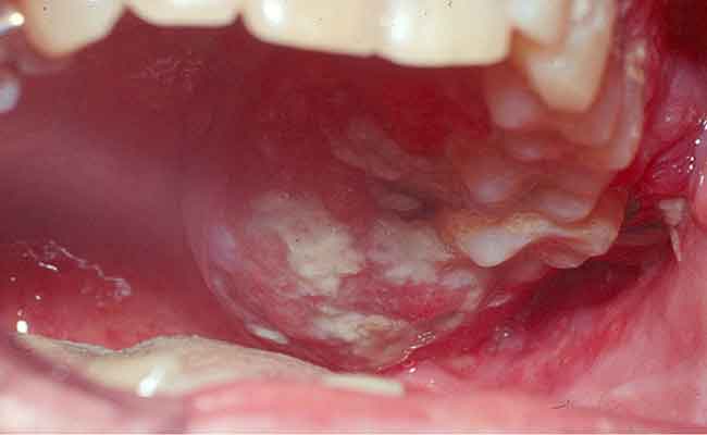 سرطان الفم والحلق: عدوى فيروسية قد تسبب المرض، فما الحل؟
