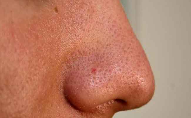 المسامات الواسعة وطرق علاجها Pore Minimizing…