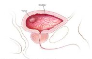 سرطان المثانة: اكتشفي أول عارض يظهر لدى 80-90% من الحالات