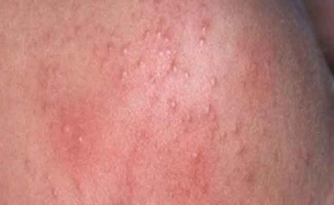 هل يسبب قماش البوليستر حساسية للبشرة؟ اكتشفي الجواب العلمي