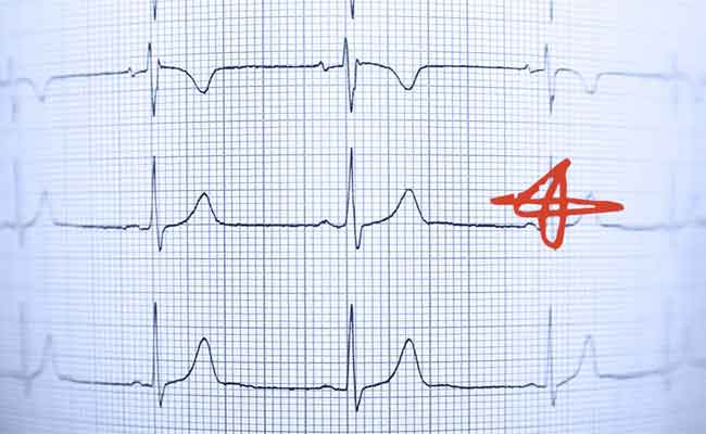 النوبة القلبية: النساء أكثر عرضة للوفاة مرتين بعد الإصابة