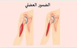 الفرق بين ضمور العضلات وضعف العضلات...التفاصيل وفق اختصاصية