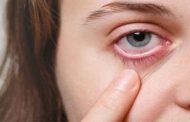 أعراض وأسباب حساسية العين خلال الصيف...الوقاية والعلاجات
