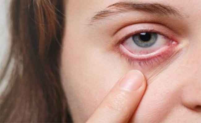 أعراض وأسباب حساسية العين خلال الصيف…الوقاية والعلاجات