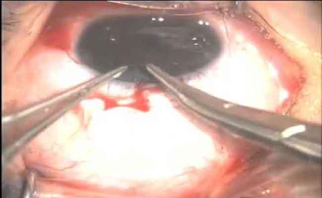 كيف يتمّ اجراء عملية زرع عدسة العين؟