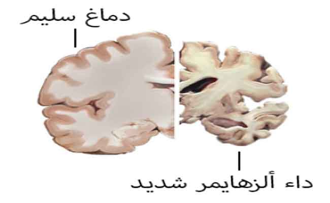 الزهايمر: علامة في البراز يمكن أن تساعد في التشخيص قبل ظهور الأعراض…