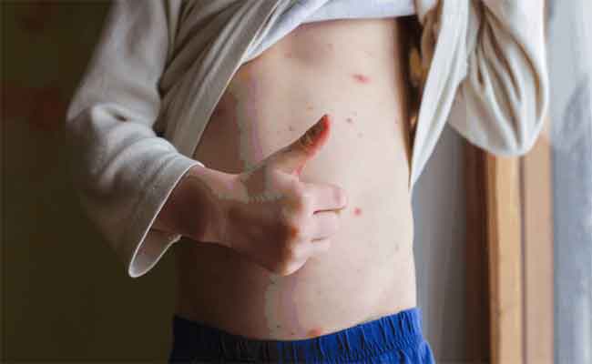 جدري الماء عند البالغين: مخاطر صحية عالية واللقاح ضروري للبعض