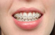 انواع تقويم الاسنان وافضلها...كل المعلومات التي تحتاجين معرفتها عنها
