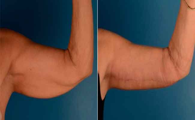 طرق للتخلص من ترهل الزنود بالتمارين في غضون أسبوع واحد فقط