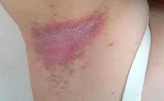 علاج فطريات الإبط بالأعشاب…بسيط ومتوفر في كل منزل