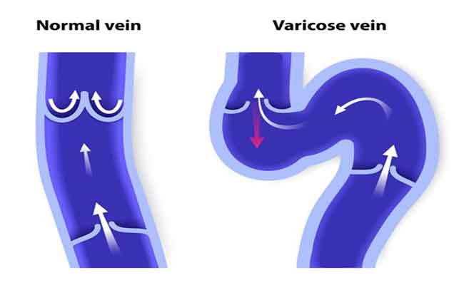 الهبات الساخنة…هل تحدث للرجل أيضاً؟