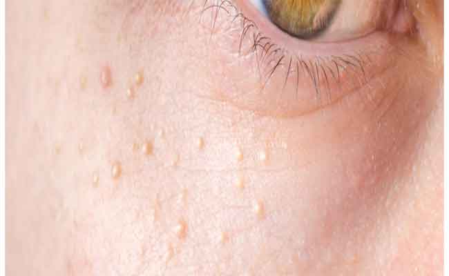 ما هي حبوب الميليا وكيف تتخلّصين منها؟