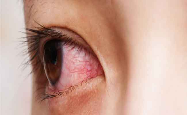 أمراض العين...احذري هذا العامل يمكن أن يسبب لك العمى
