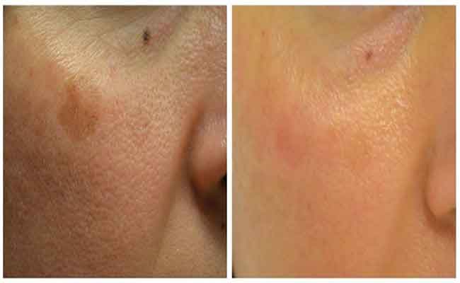 ما هي الحلول المتاحة لعلاج البقع البنيّة التي تظهر على البشرة؟