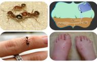 فوائد قرصة النمل عديدة...اكتشفيها واكتشفي طرق تخفيف الألم