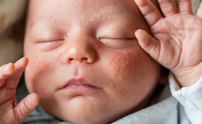 أنواع البثور على وجه طفلك الرضيع وأسبابها وطرق التعامل معها…