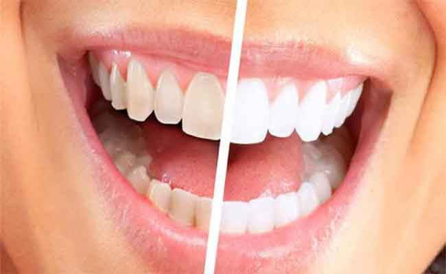طريقة إزالة جير الأسنان بالمنزل…ببعض الخطوات البسيطة