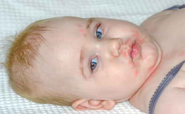 أسباب بثور الشفاه عند الأطفال الرُّضَّع وما هي طرق علاجها؟