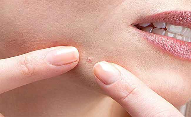 كيفية التخلص من عادة فقع الحبوب من الوجه…نهائياً